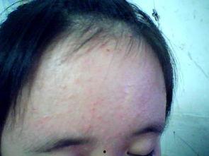 额头缝针可以吃网瓜,网瓜助力康复之旅